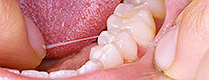 歯のクリーニング・予防歯科